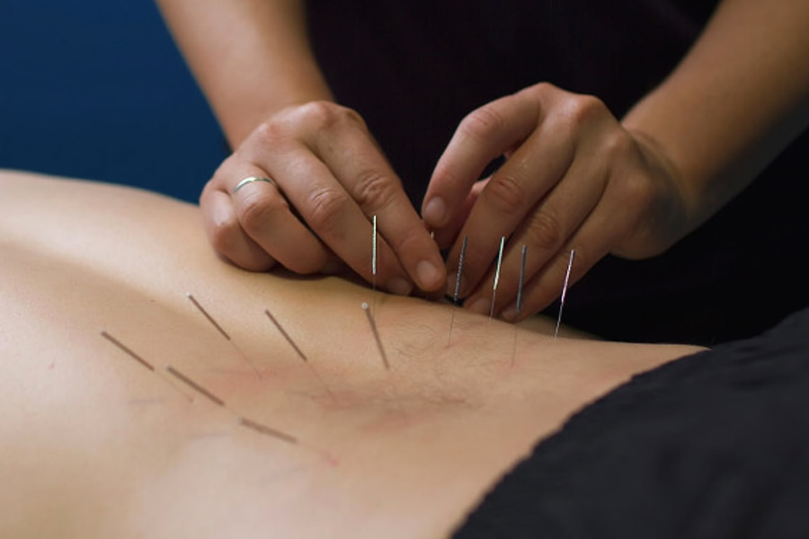 dry-needling